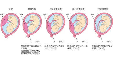 低位胎盤改善